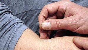 Arm und Hand mit Akupunkturnadel